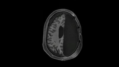 MRI of brain with one complete hemisphere