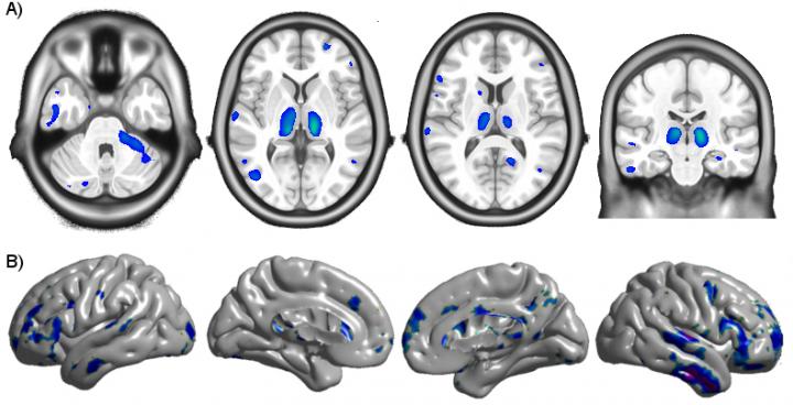 Brain Atrophy in HIV