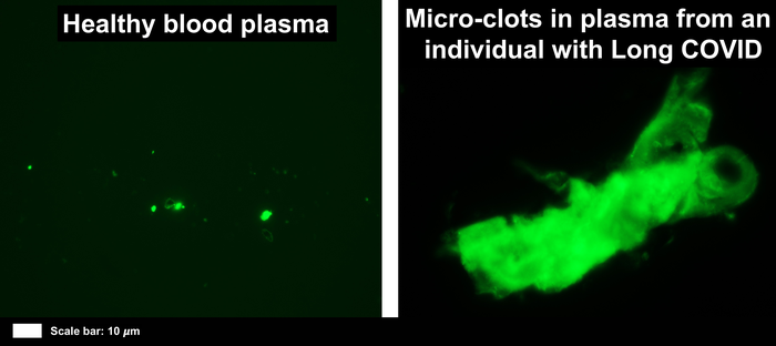 Fluorescent image of micro blood clots in sample from individuals with Long-COVID