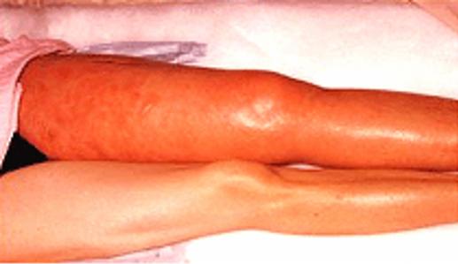 Patient with Blood Clot in Leg