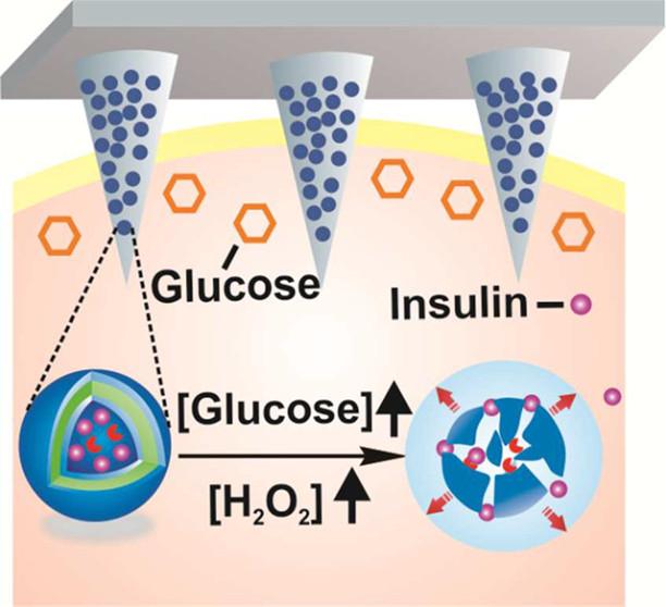 Toward a 'Smart' Patch That Automatically Delivers Insulin When Needed