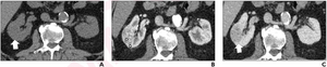 72-year-old man with right interpolar 3.2-cm renal mass