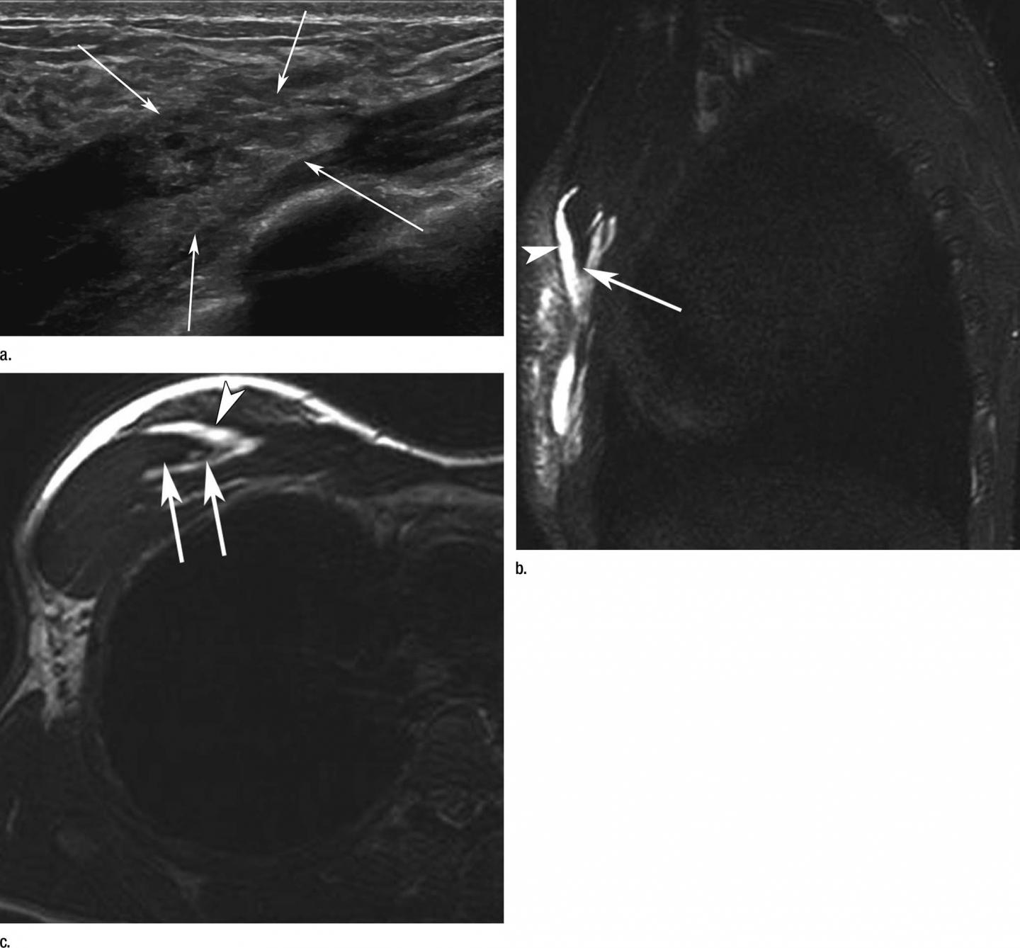 Images in a Tennis Player with Acute Pain at Anterior Chest Wall after a Match