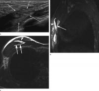 Images in a Tennis Player with Acute Pain at Anterior Chest Wall after a Match