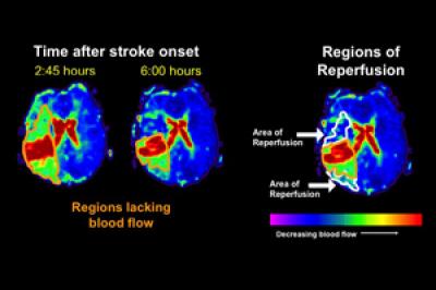 Stroke MRIs