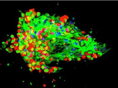 How the Body Aids and Abets the Spread of Cancer