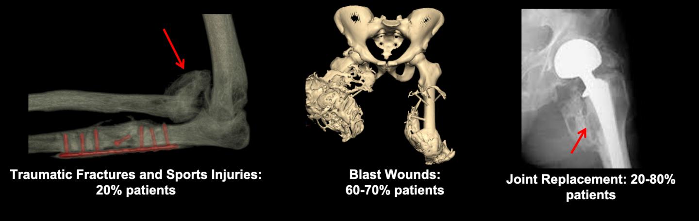 Primary Hip Replacement: 20% of patients 