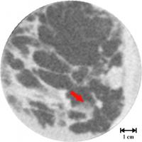 Breast Image in Conventional Computed Tomography