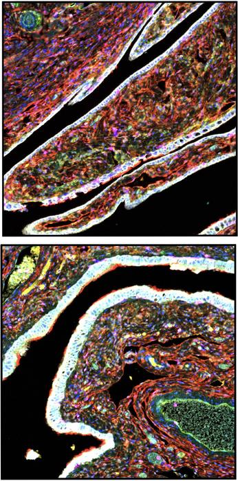 Fallopian tube tissue showing high-risk MSCs