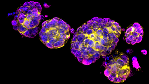 Breast Cancer Organoids