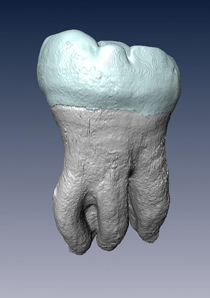 Three-Rooted Lower Second Molar