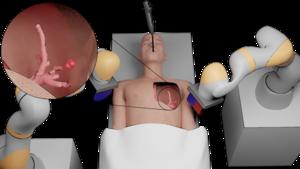 Magnetic personalized tentacles for targeted photothermal cancer therapy in peripheral lungs