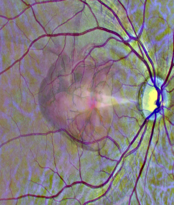 Using the eye as a window into heart disease