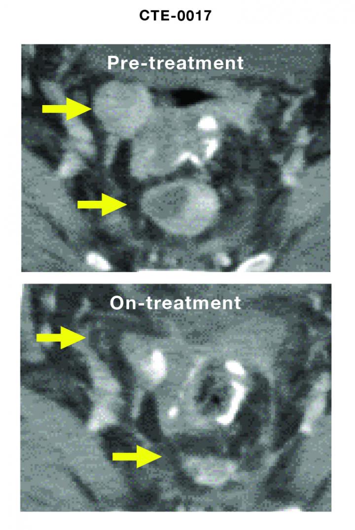 Training the Immune System to Fight Ovarian Cancer (2 of 2)