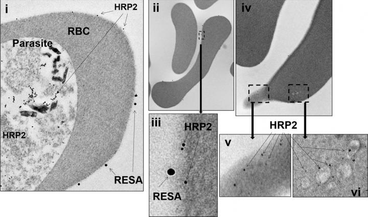 Simple Blood Test Predicts Anemia Risk After Malaria Treatment