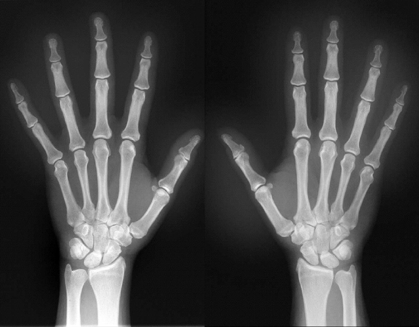 X-Ray Image of Hands of RA Patient (1 of 2)