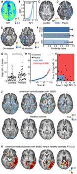 Ben-Gurion U. Researchers Reveal Persistent BBBD in American Football Players