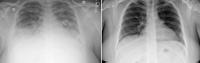 Lung Scanes