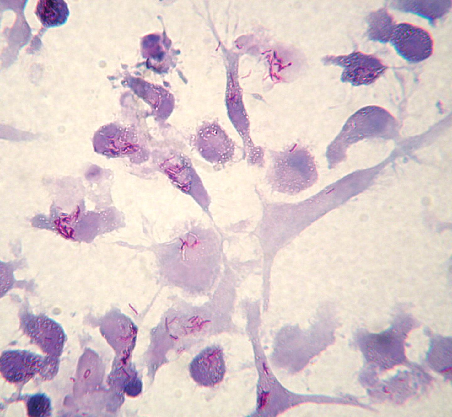 At Long Last, A Urine Test for Accurate Tuberculosis Detection ( 3 of 6)