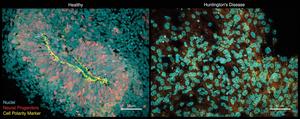 Healthy organoids (left) show an organized neurogenic zone (shown in yellow) and neural progenitor cells (shown in red/pink).