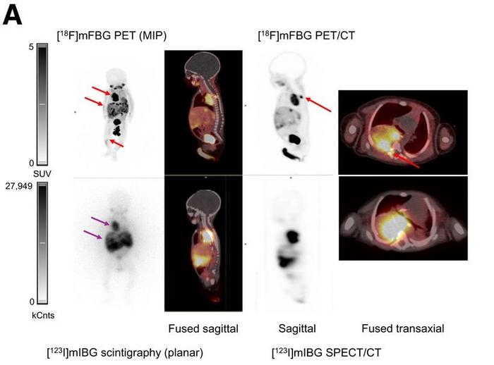 Novel PET/CT technique accurately detects neu | EurekAlert!