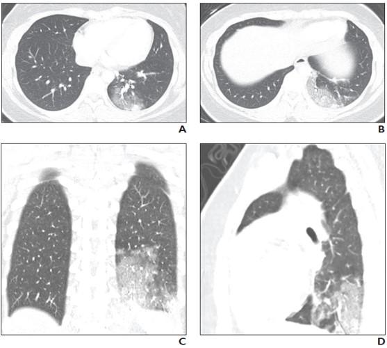 16 YO girl with COVID-19 who presented with shortness of breath