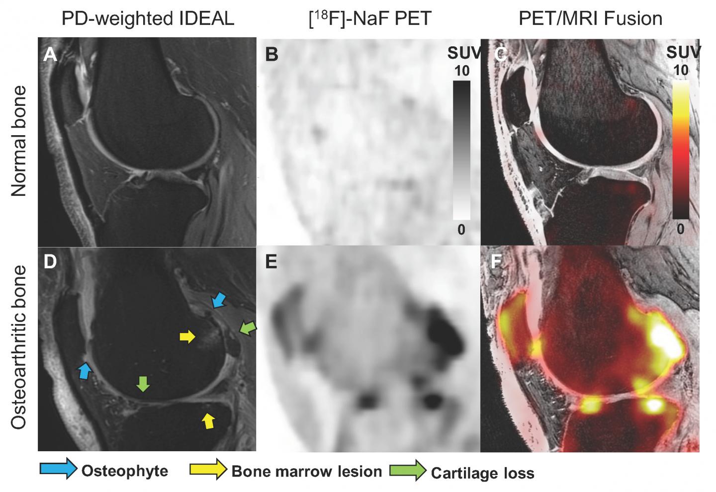 Bone imaging of knee osteoarthritis