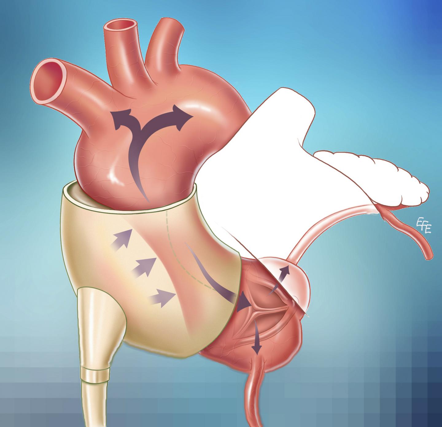 Implanted Cuff around the Aorta Could Be Breakthrough in Heart Failure Therapy