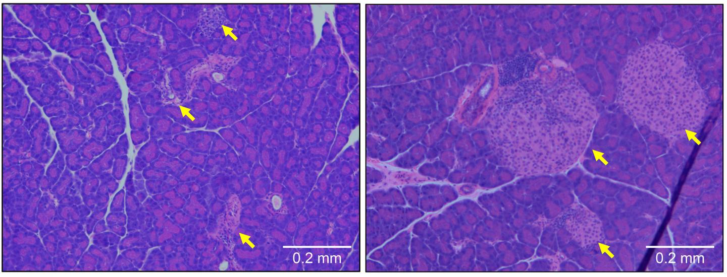 type 1 diabetes pancreas histology