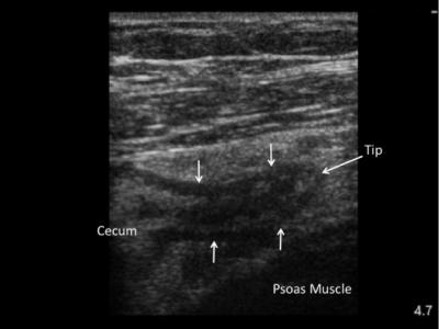 Ultrasound Image of Appendicitis