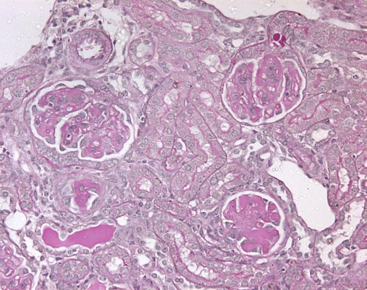 IL-17A/F and Th17 Cells Contribute to Renal Injury