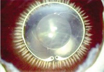 Artificial Lens