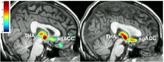 Placebo Vs. Real Drug: Brain Chemistry Changes Predict Symptom Response