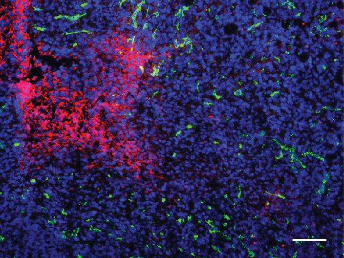 Tumor After Anti-angiogenic Therapy