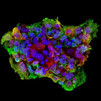 Researchers Found a Possible New Treatment for Aggressive Triple Receptor-Negative Breast Cancer