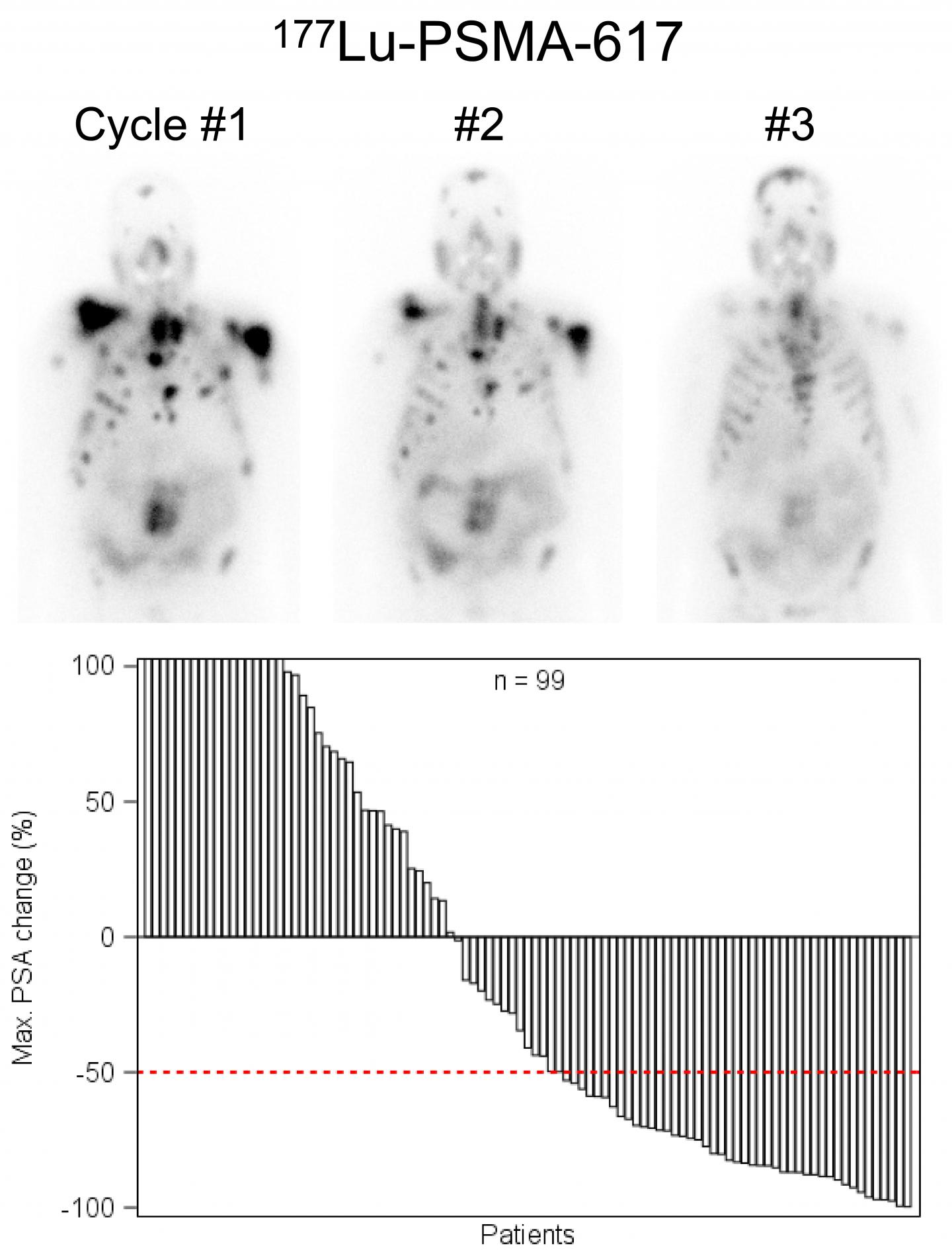 Lu-177-PSMA-617 Radionuclide Therapy