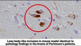 Misfolded Proteins Cause Parkinson's-Like Condition in Mice (3 of 3)