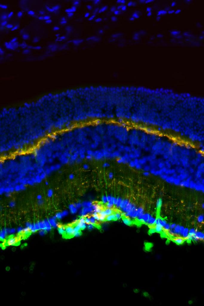 Retina May Be Sensitive Gauge of Blast-Wave Pressure Injury
