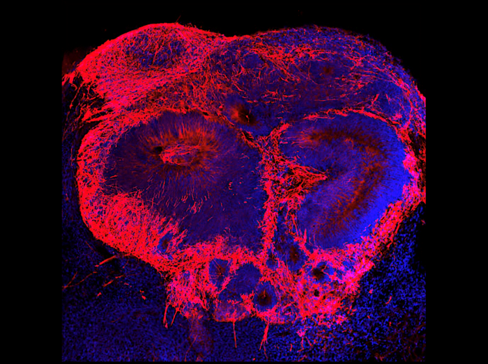 Schizophrenia brain organoid