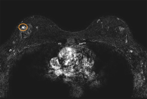 Breast screening MRI