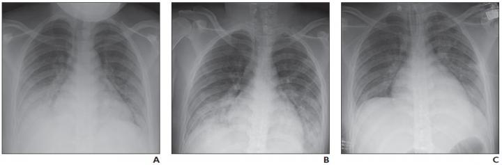 16 YO girl with COVID-19 and known history of tuberous sclerosis who presented with acute hypoxic respiratory distress