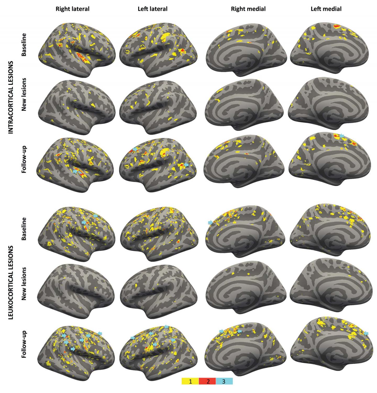 HighStrength MRI Tracks MS Pr [IMAGE] EurekAlert! Science News Releases