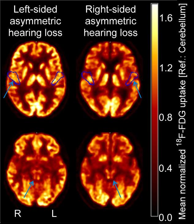 Axial 18F-FDG PET scans at level of primary auditory cortex and inferior colliculus.