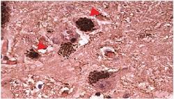 a-synuclein in a Brain with Parkinson's