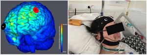 Transcranial direct current stimulation (tDCS)