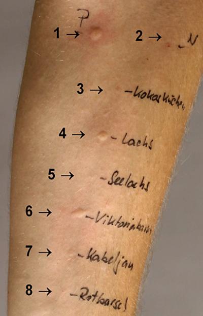 Allergy Test