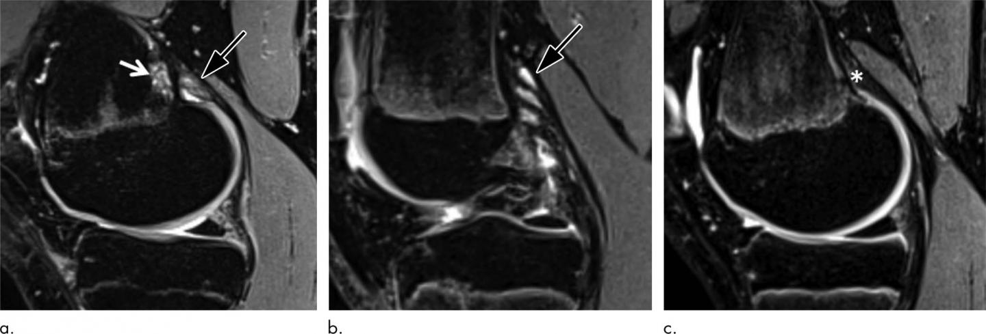 Irregular Findings Common in Knees of Young Competitive Alpine Skiers