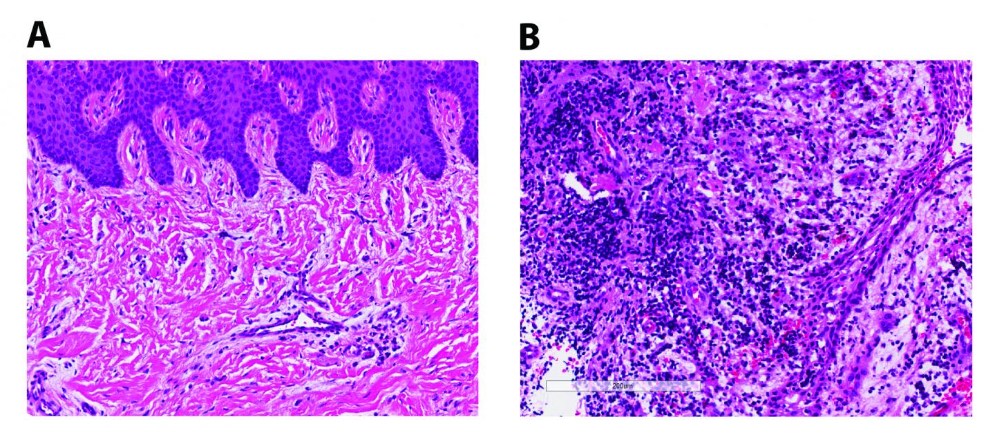 Rogue Immune Cells Underlie a Common Gum Disease (1 of 2)