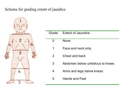 Neonatal Jaundice Scale