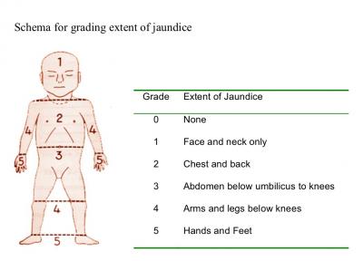 jaundice newborns extent hyperbilirubinemia neonatal nurses farthest examined risk bilirubin bayi rely chop medyczne pytanie inspection jaundiced assessing esciencenews jaundis